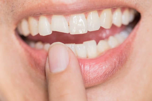 Broken tooth needs crown